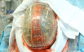 Breakthrough: World's First Complete Skull Transplant Uses 3D Printing ... - Medical Daily