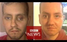 '3D printer helped rebuild my face' - BBC News
