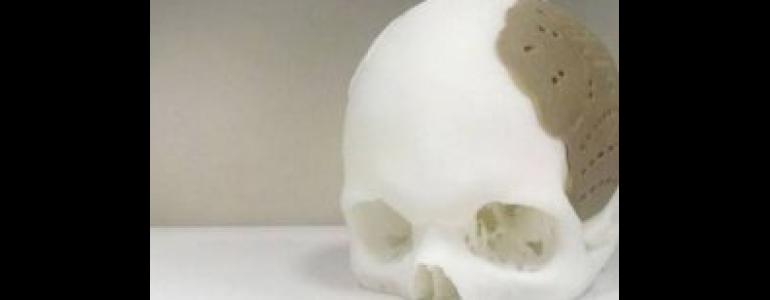 Muazzam olay! 3D Yazıcı ile kafatası kemiği yapılacak - Teknokopat