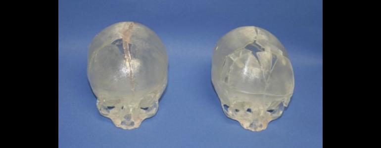 Surgeons reconstruct baby's skull with 3D printing technology - Fox News