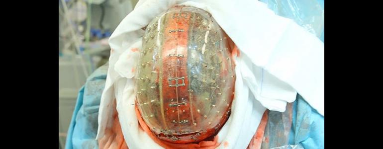 Breakthrough: World's First Complete Skull Transplant Uses 3D Printing ... - Medical Daily